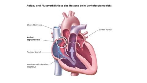Abbildung Vorhofseptumdefekt