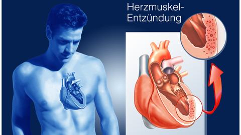 Junger Mann mit Herzmuskelentzündung