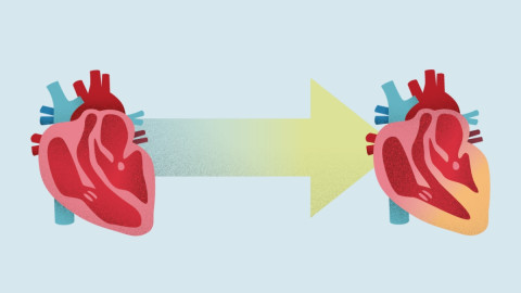 Grafik zeigt, wie sich der Herzmuskel bei der kardialen Amyloidose versteift